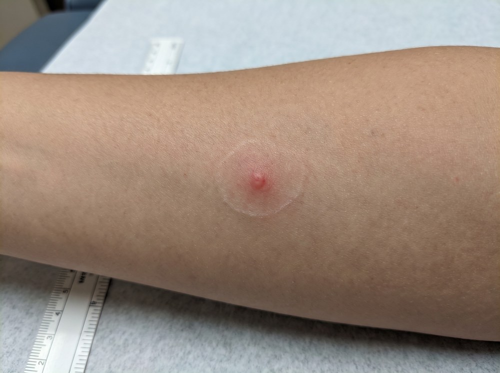 Close-up photo of a fresh bold jumping spider bite mark showing a small red bump with mild swelling and no blistering or ulceration